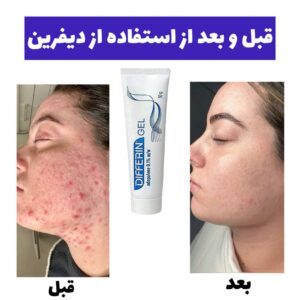 قبل و بعد از استفاده از ژل ضد جوش دیفرین