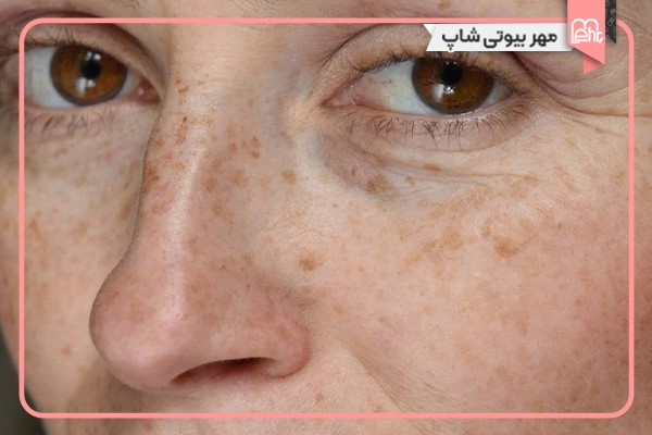 افزایش سن؛ وقتی پوست کمکم تغییر میکنه