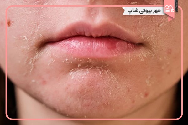 آیا استفاده از کرم آبرسان عوارضی دارد؟