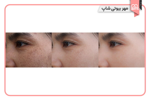 روش های کلینیکی برای از بین بردن لک قهوه ای صورت
