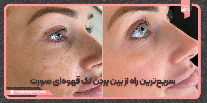 آموزش سریع ترین راه از بین بردن لک قهوه ای صورت
