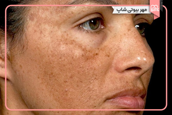 لکهای ملاسما (لکهای بارداری)