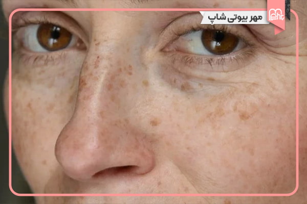 لکهای ناشی از آفتاب (لکهای خورشیدی)