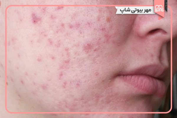 لکهای جای جوش (آکنه اسکار)