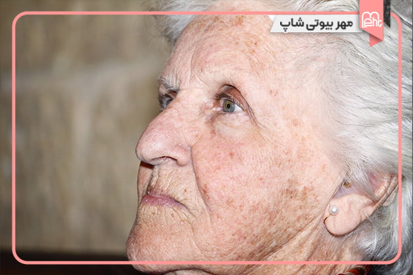 لکهای پیری (لکههای کبدی یا سن)