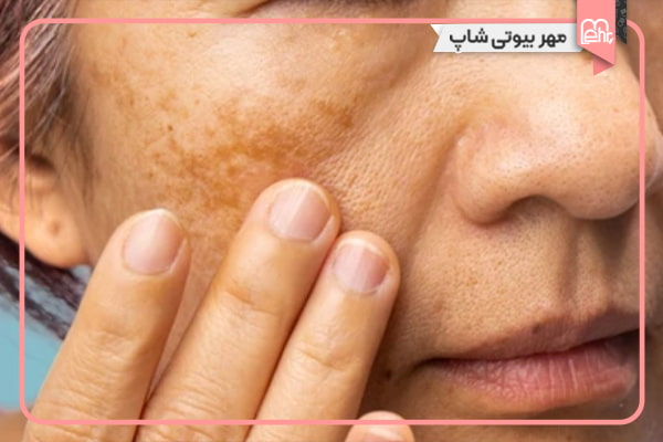 لکهای هورمونی (لکهای اضطرابی)