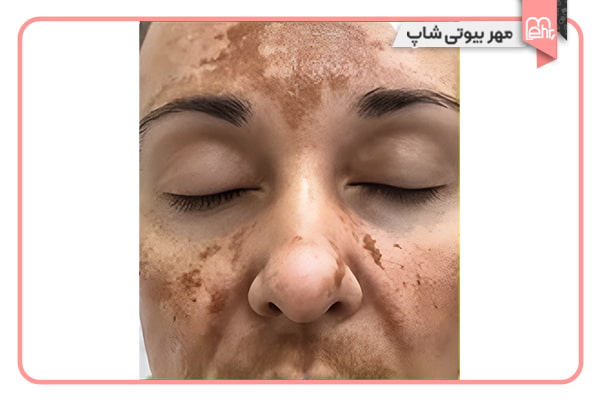 لکهای ناشی از مواد شیمیایی (لکهای شیمیایی)