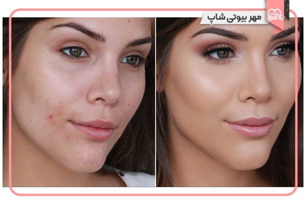 پوشاندن جای جوش