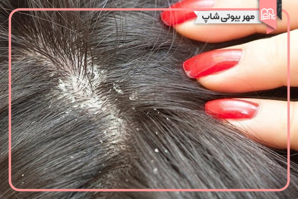 درمان شوره سر با روغن رزماری امکان پذیر است