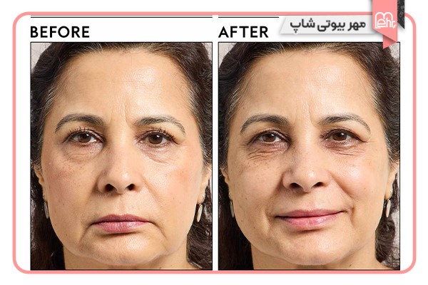 مزایای استفاده از میسلار واتر