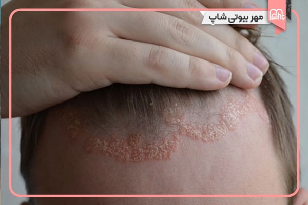 روغن سیاه دانه دارای خواص آنتیاکسیدانی است