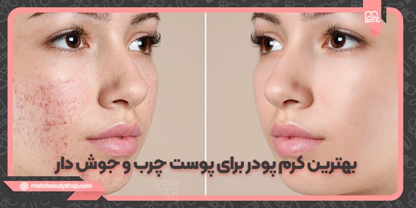 بهترین کرم پودر برای پوست چرب و جوش دار