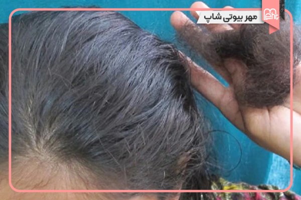 روغن سیاه دانه ریزش مو را کاهش دهد.