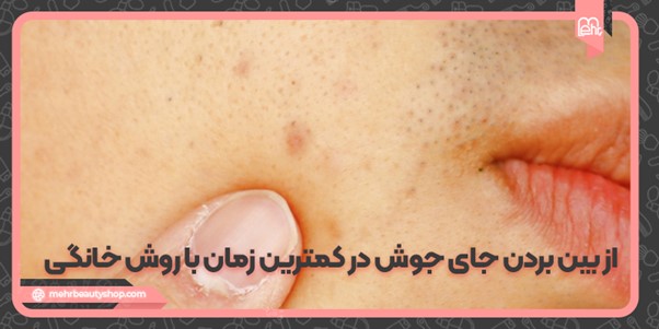 از بین بردن جای جوش در کمترین زمان با روش خانگی