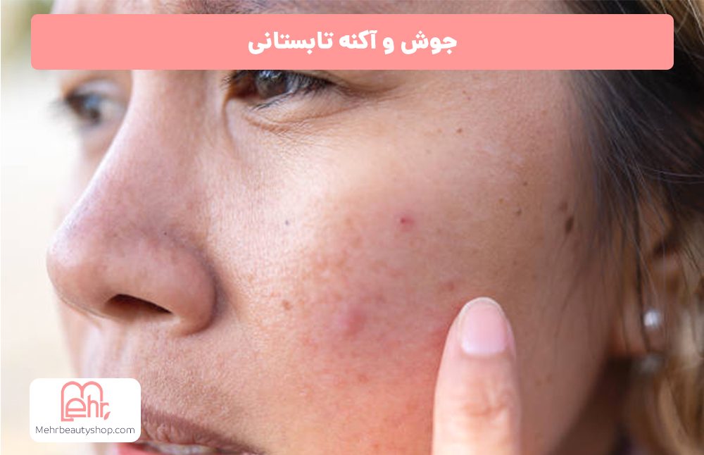 جوش و آکنه تابستانی