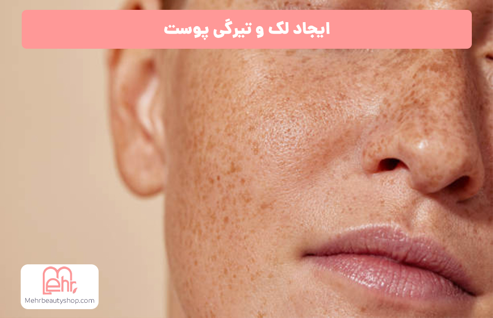 لک و تیرگی در صورت تابستان